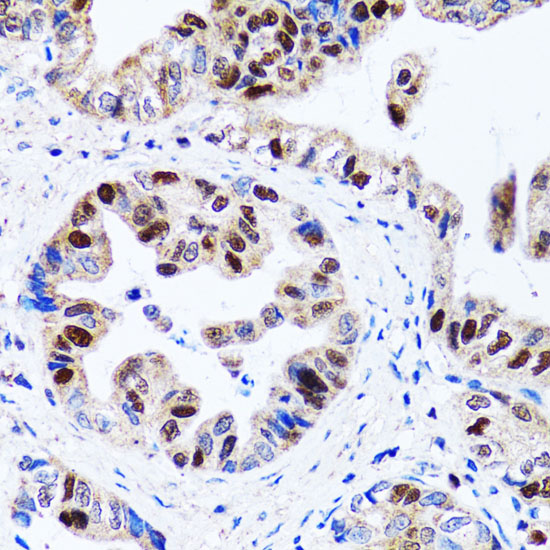 Immunohistochemistry of paraffin-embedded Human gastric cancer using UHRF1 Polyclonal Antibody at dilution of 1:100 (40x lens).