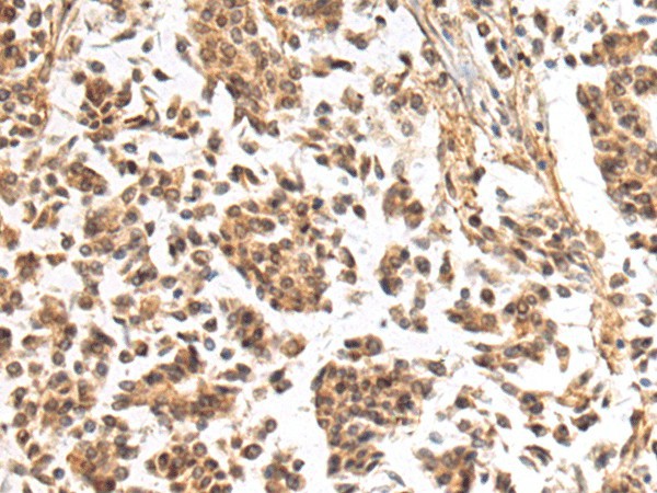 Immunohistochemistry of paraffin-embedded Human breast cancer tissue  using NHLRC2 Polyclonal Antibody at dilution of 1:40(?200)