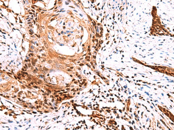 Immunohistochemistry of paraffin-embedded Human esophagus cancer tissue  using TSEN2 Polyclonal Antibody at dilution of 1:60(?200)