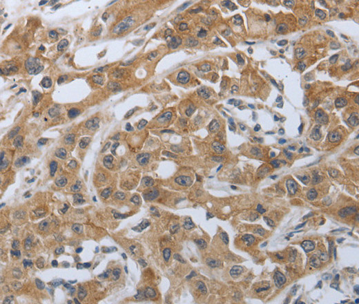 Immunohistochemistry of paraffin-embedded Human lung cancer tissue using PD-1/CD279 Polyclonal Antibody at dilution 1:50