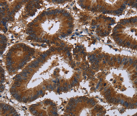 Immunohistochemistry of paraffin-embedded Human colon cancer using CERS5 Polyclonal Antibody at dilution of 1:35