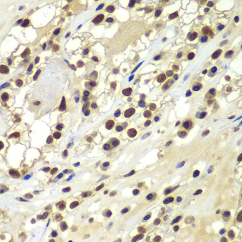 Immunohistochemistry of paraffin-embedded Human kidney cancer using PRKDC Polyclonal Antibody at dilution of 1:100 (40x lens).