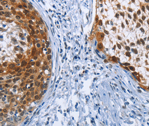 Immunohistochemistry of paraffin-embedded Human cervical cancer tissue using CRABP2 Polyclonal Antibody at dilution 1:40