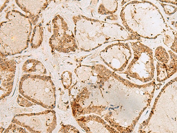 Immunohistochemistry of paraffin-embedded Human thyroid cancer tissue  using H3F3B Polyclonal Antibody at dilution of 1:40(?200)