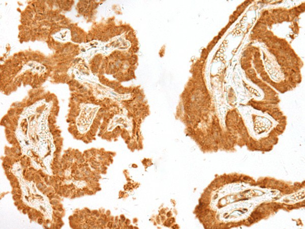 Immunohistochemistry of paraffin-embedded Human thyroid cancer tissue  using GANC Polyclonal Antibody at dilution of 1:55(?200)