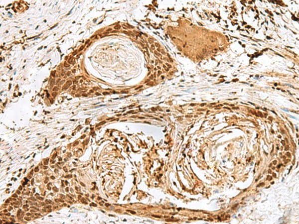 Immunohistochemistry of paraffin-embedded Human esophagus cancer tissue  using SNAPC1 Polyclonal Antibody at dilution of 1:40(?200)