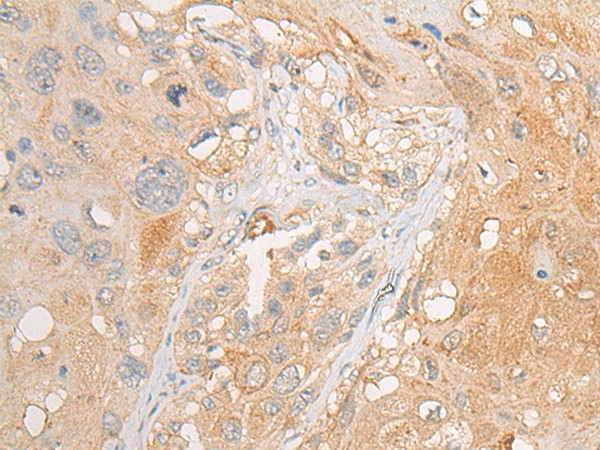 Immunohistochemistry of paraffin-embedded Human esophagus cancer tissue  using PCDHGB5 Polyclonal Antibody at dilution of 1:35(?200)