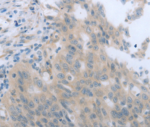 Immunohistochemistry of paraffin-embedded Human breast cancer tissue using TNK2 Polyclonal Antibody at dilution 1:70