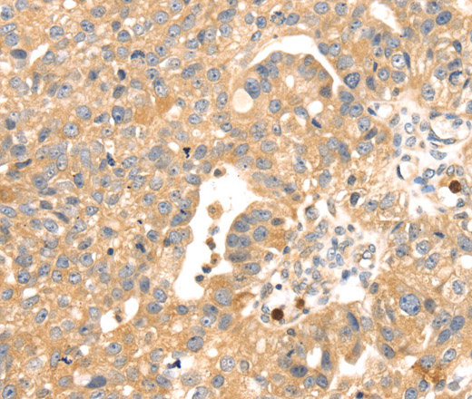 Immunohistochemistry of paraffin-embedded Human breast cancer tissue using S100A12 Polyclonal Antibody at dilution 1:45