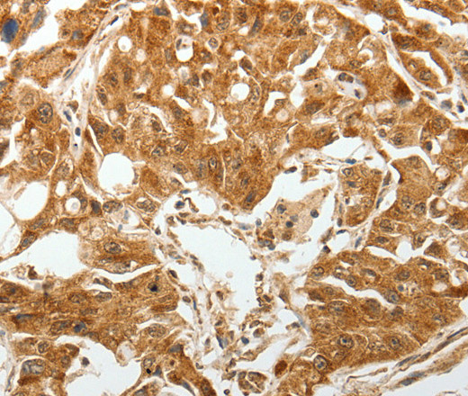 Immunohistochemistry of paraffin-embedded Human lung cancer tissue using TGF β Receptor I Polyclonal Antibody at dilution 1:60