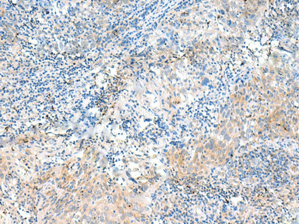 Immunohistochemistry of paraffin-embedded Human cervical cancer tissue  using NID2 Polyclonal Antibody at dilution of 1:50(?200)