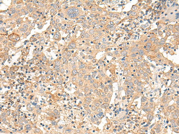 Immunohistochemistry of paraffin-embedded Human cervical cancer tissue  using CORO2A Polyclonal Antibody at dilution of 1:30(?200)