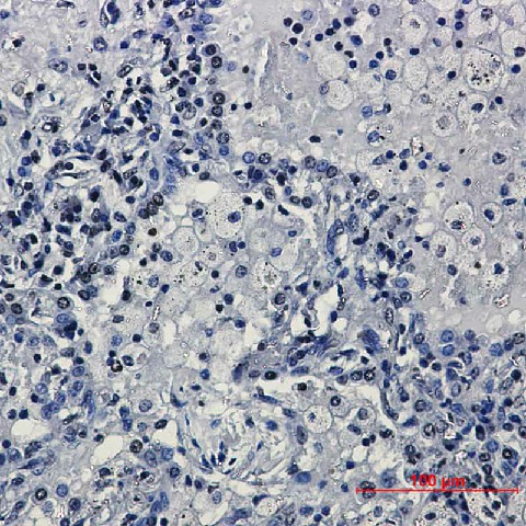 Immunohistochemical of TriMethyl-Histone H3 (Lys27) in Human lung cancer tissue using TriMethyl-Histone H3 (Lys27) antibody at dilution 1:20