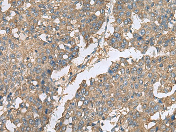 Immunohistochemistry of paraffin-embedded Human liver cancer tissue  using EIF1AX Polyclonal Antibody at dilution of 1:65(?200)