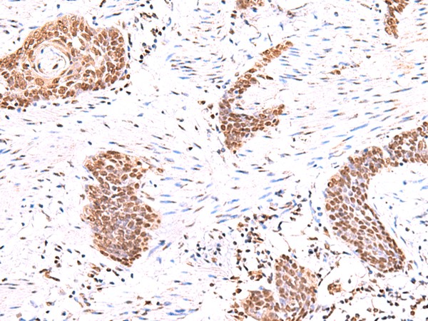 Immunohistochemistry of paraffin-embedded Human esophagus cancer tissue  using ACTL6B Polyclonal Antibody at dilution of 1:55(?200)