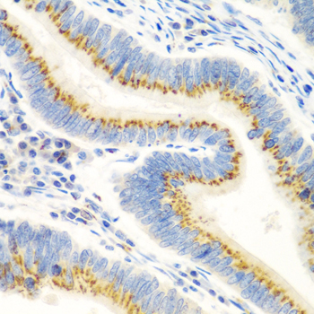 Immunohistochemistry of paraffin-embedded human colon carcinoma using UBIAD1 Polyclonal Antibody at dilution of 1:100 (40x lens).Perform microwave antigen retrieval with 10 mM PBS buffer pH 7.2 before commencing with IHC staining protocol.