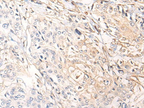 Immunohistochemistry of paraffin-embedded Human prost ate cancer tissue  using NREP Polyclonal Antibody at dilution of 1:35(?200)