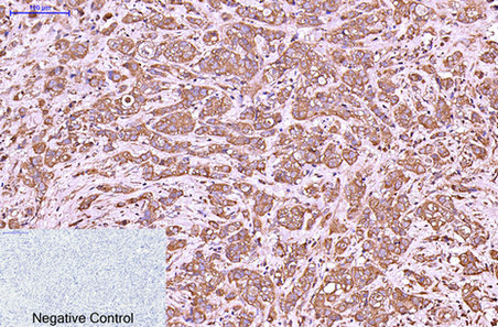 Immunohistochemistry of paraffin-embedded Human breast cancer tissue using CK-6A/B/C Monoclonal Antibody at dilution of 1:200.