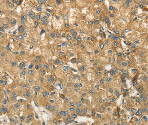 Immunohistochemistry of paraffin-embedded Human liver cancer using HSD17B8 Polyclonal Antibody at dilution of 1:55