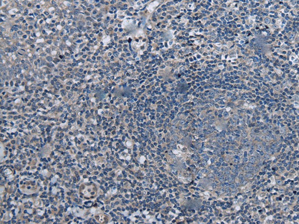 Immunohistochemistry of paraffin-embedded Human tonsil tissue  using UBR4 Polyclonal Antibody at dilution of 1:55(?200)