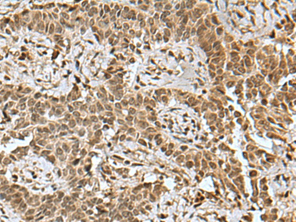 Immunohistochemistry of paraffin-embedded Human ovarian cancer tissue  using BCL7B Polyclonal Antibody at dilution of 1:85(?200)