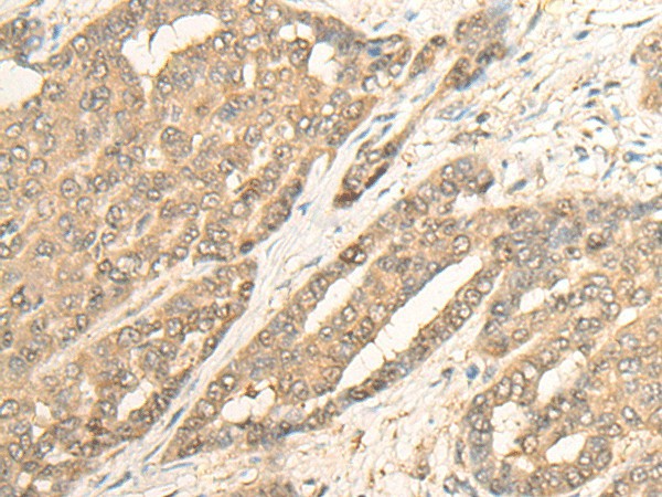 Immunohistochemistry of paraffin-embedded Human liver cancer tissue  using IMPA1 Polyclonal Antibody at dilution of 1:25(?200)