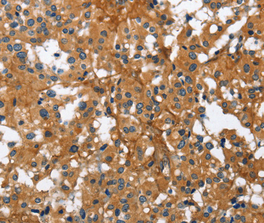 Immunohistochemistry of paraffin-embedded Human thyroid cancer tissue using BGN Polyclonal Antibody at dilution 1:50