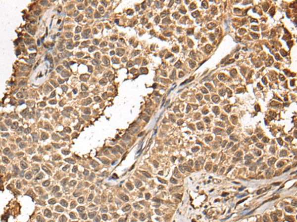 Immunohistochemistry of paraffin-embedded Human ovarian cancer tissue  using BUD31 Polyclonal Antibody at dilution of 1:45(?200)