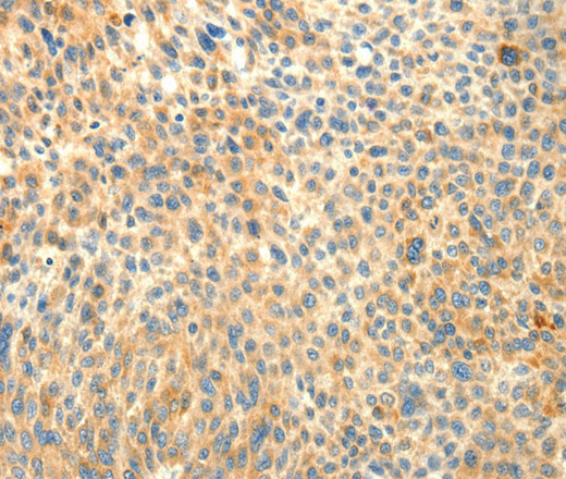 Immunohistochemistry of paraffin-embedded Human liver cancer using TRAF3IP2 Polyclonal Antibody at dilution of 1:30