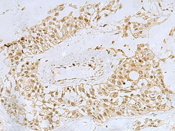 Immunohistochemistry of paraffin-embedded Human colorectal cancer tissue  using FOXQ1 Polyclonal Antibody at dilution of 1:30(?200)