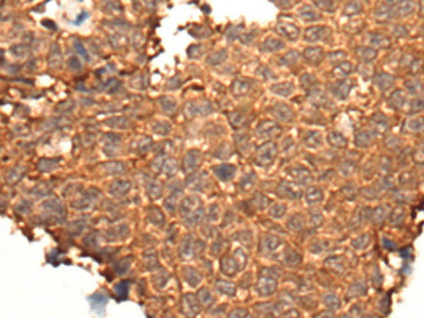 Immunohistochemistry of paraffin-embedded Human ovarian cancer tissue  using HOXD8 Polyclonal Antibody at dilution of 1:40(?200)