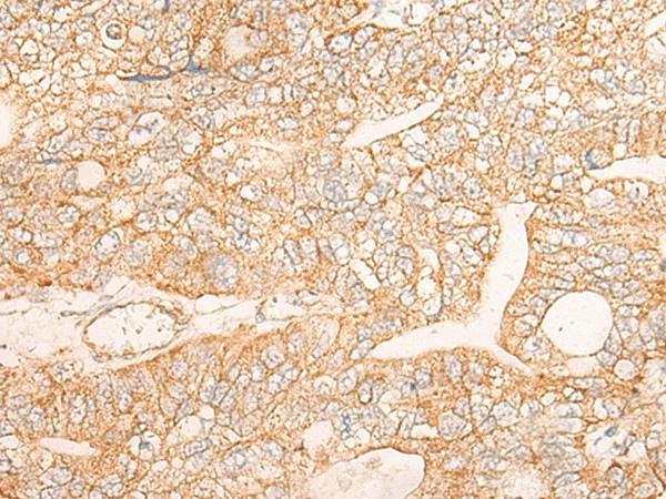 Immunohistochemistry of paraffin-embedded Human gastric cancer tissue  using KRT9 Polyclonal Antibody at dilution of 1:30(?200)