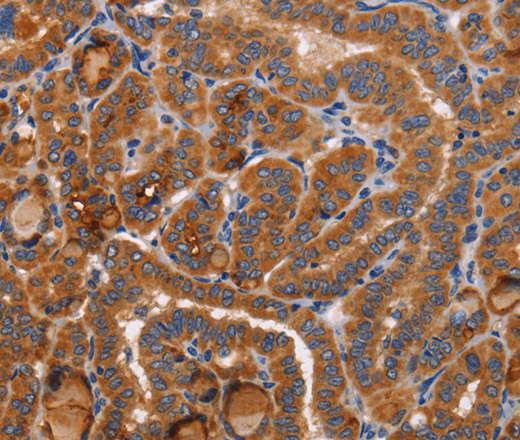 Immunohistochemistry of paraffin-embedded Human thyroid cancer tissue using BMP6 Polyclonal Antibody at dilution 1:40