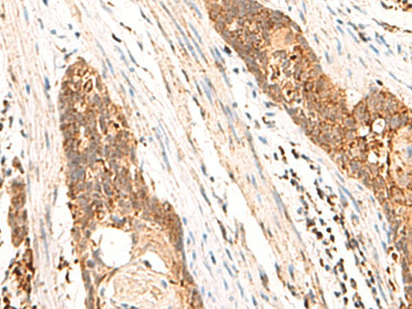 Immunohistochemistry of paraffin-embedded Human esophagus cancer tissue  using CYYR1 Polyclonal Antibody at dilution of 1:85(?200)