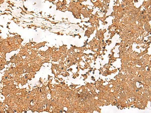 Immunohistochemistry of paraffin-embedded Human lung cancer tissue  using SMOC1 Polyclonal Antibody at dilution of 1:35(?200)