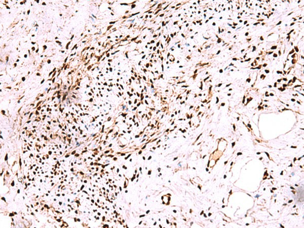 Immunohistochemistry of paraffin-embedded Human cervical cancer tissue  using CDKN1B Polyclonal Antibody at dilution of 1:75(?200)