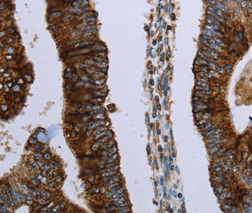 Immunohistochemistry of paraffin-embedded Human colon cancer using HMGCL Polyclonal Antibody at dilution of 1:30