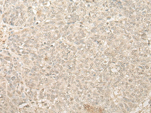 Immunohistochemistry of paraffin-embedded Human ovarian cancer tissue  using FYTTD1 Polyclonal Antibody at dilution of 1:25(?200)