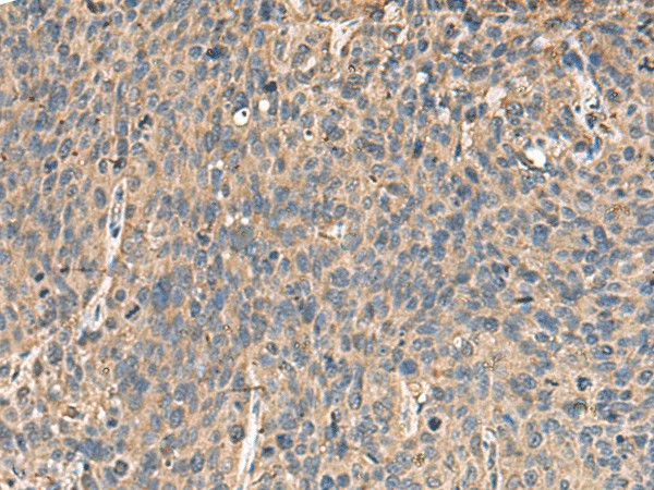 Immunohistochemistry of paraffin-embedded Human cervical cancer tissue  using MRPL42 Polyclonal Antibody at dilution of 1:65(?200)