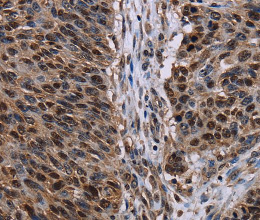 Immunohistochemistry of paraffin-embedded Human lung cancer tissue using KDM3B Polyclonal Antibody at dilution 1:50