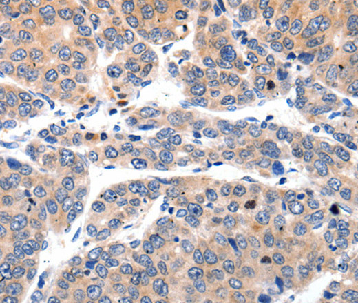 Immunohistochemistry of paraffin-embedded Human liver cancer using MYL9 Polyclonal Antibody at dilution of 1:80