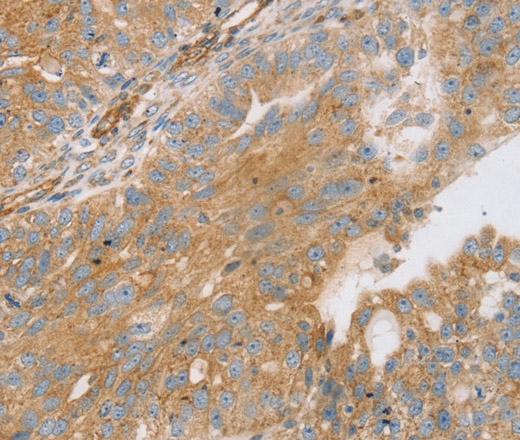 Immunohistochemistry of paraffin-embedded Human breast cancer using STX16 Polyclonal Antibody at dilution of 1:30