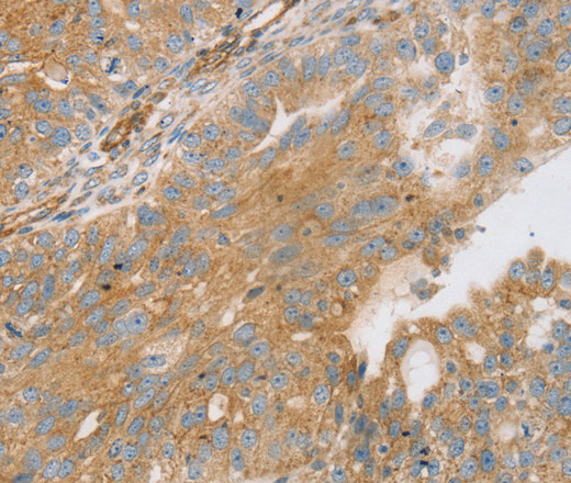 Immunohistochemistry of paraffin-embedded Human breast cancer using STX16 Polyclonal Antibody at dilution of 1:30