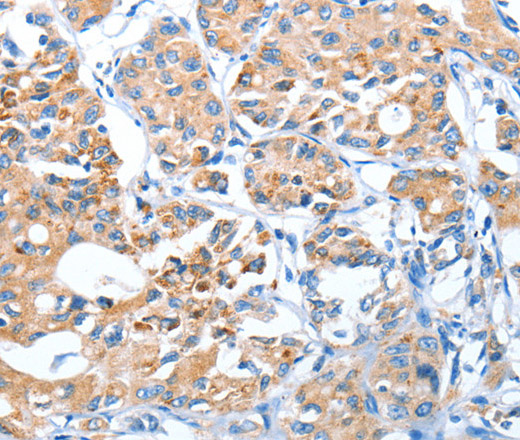 Immunohistochemistry of paraffin-embedded Human lung cancer using AUP1 Polyclonal Antibody at dilution of 1:50