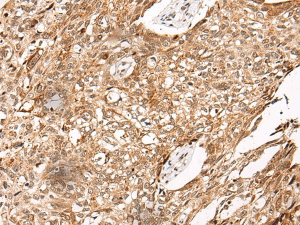 Immunohistochemistry of paraffin-embedded Human lung cancer tissue  using C14orf169 Polyclonal Antibody at dilution of 1:45(?200)