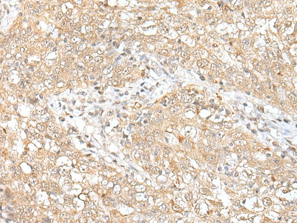 Immunohistochemistry of paraffin-embedded Human esophagus cancer tissue  using CHRNB2 Polyclonal Antibody at dilution of 1:50(?200)