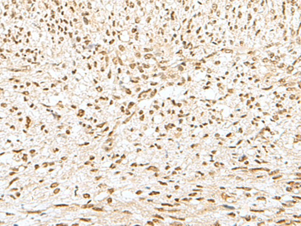 Immunohistochemistry of paraffin-embedded Human liver cancer tissue  using GTF2A2 Polyclonal Antibody at dilution of 1:30(?200)