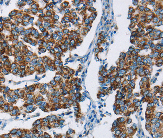 Immunohistochemistry of paraffin-embedded Human breast cancer using HINT2 Polyclonal Antibody at dilution of 1:50