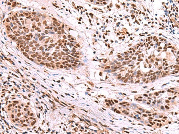 Immunohistochemistry of paraffin-embedded Human esophagus cancer tissue  using SF3B3 Polyclonal Antibody at dilution of 1:70(?200)