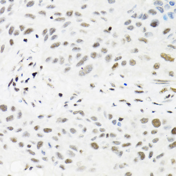 Immunohistochemistry of paraffin-embedded Human lung cancer using TRMT2A Polyclonal Antibody at dilution of  1:100 (40x lens).